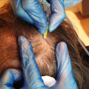 Trattamenti medicina estetica Monza - Carbossiterapia per alopec