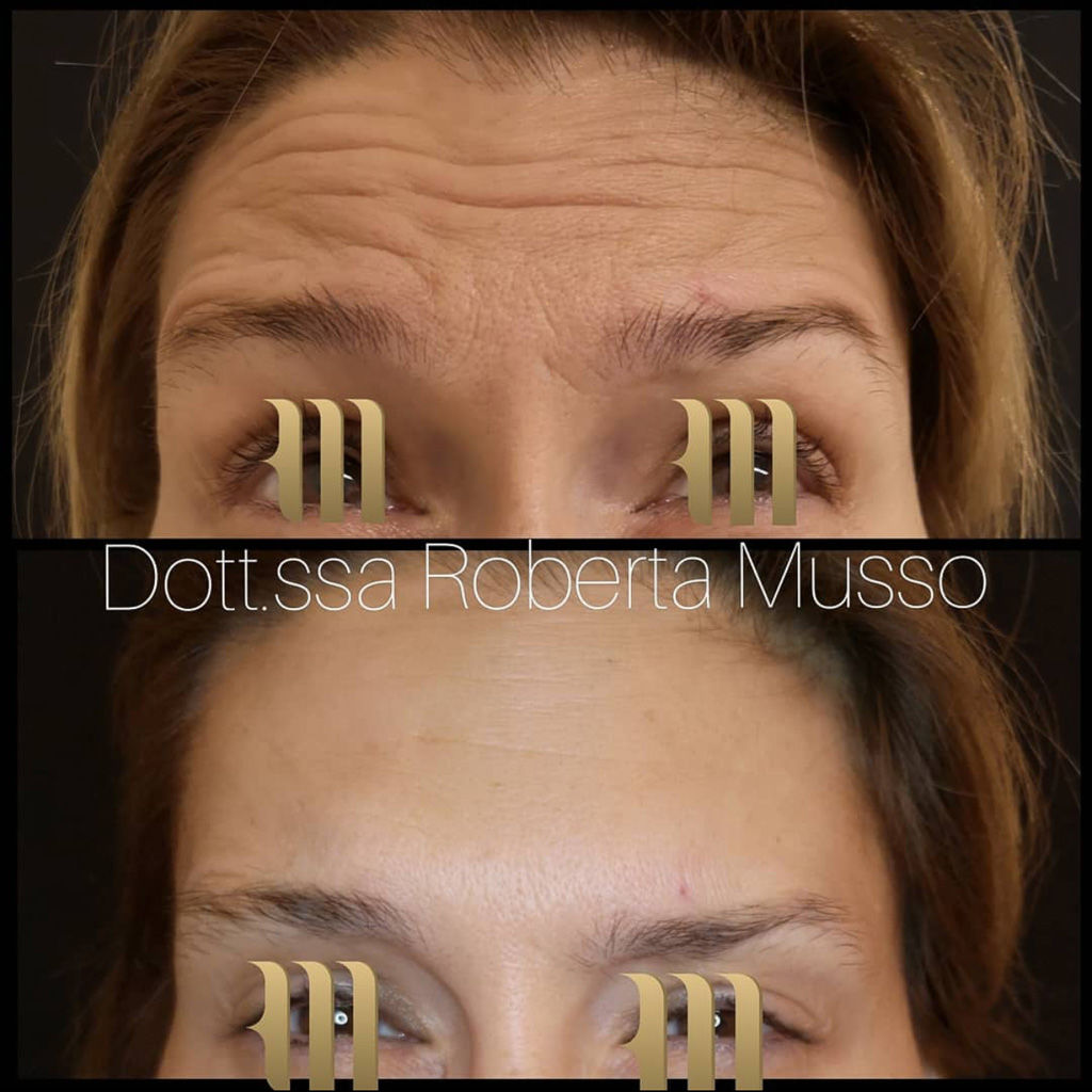 Trattamenti medicina estetica Monza - botox