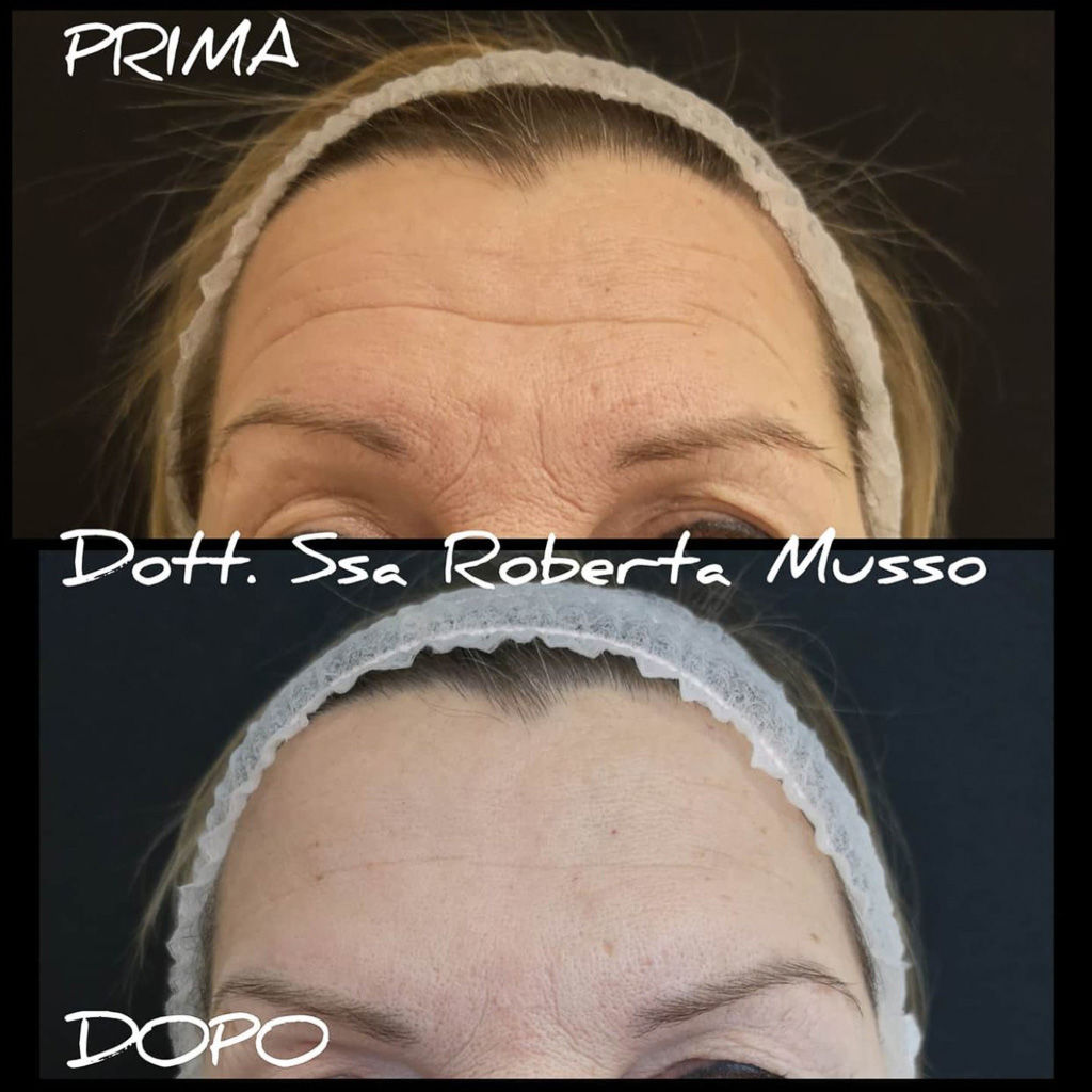 Trattamenti medicina estetica Monza - tossina botox