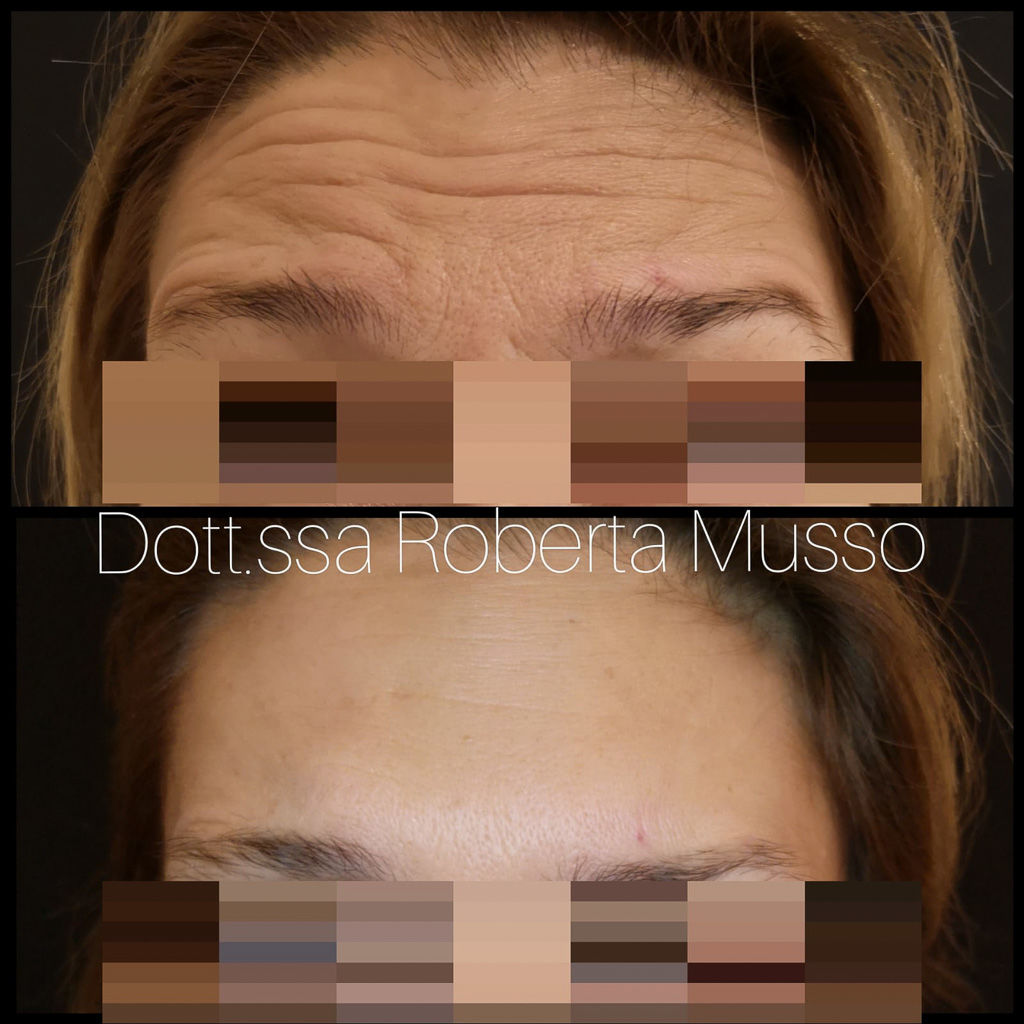 Distensione rughe con botox Brianza - Kinesis Sport